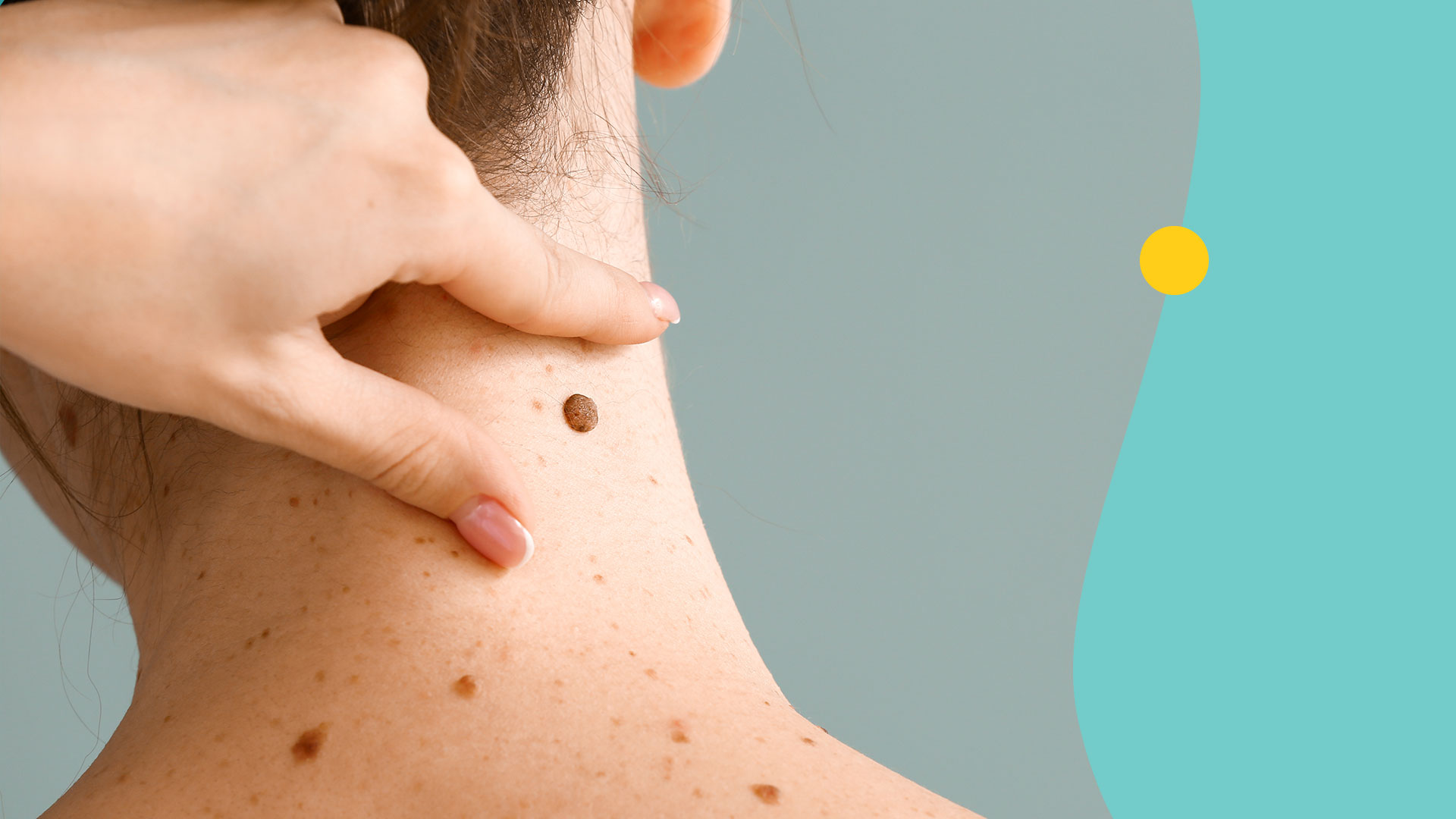 person with moles on their back