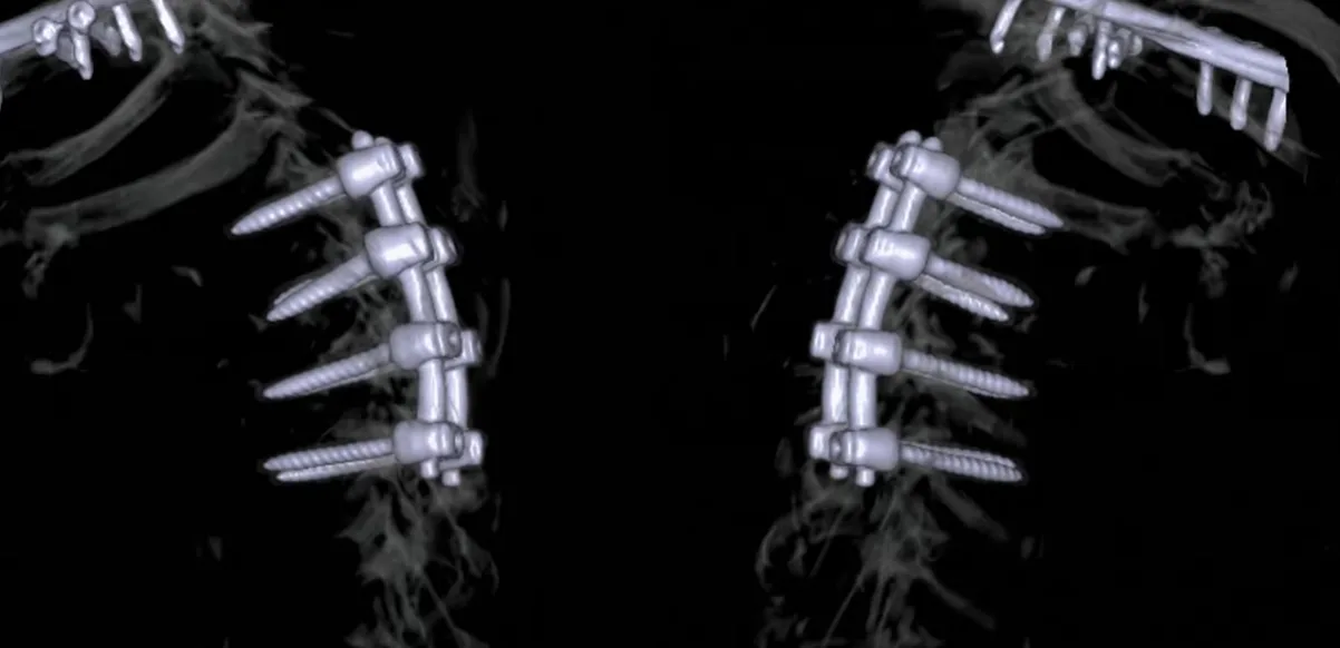 X-ray image of Ozzy Osbourne's bones with multiple screws in his bones.