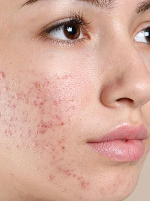 Can Acne Look Like A Rash? – Balmonds