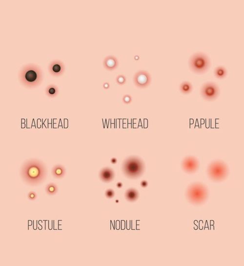 Types of Acne Chart