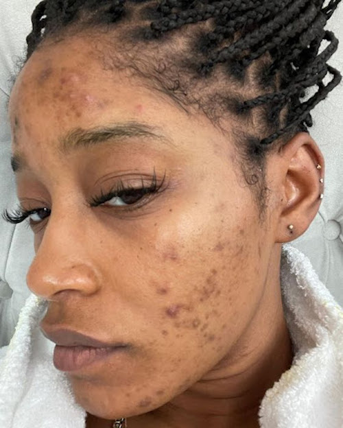 Hyperpigmentation 3