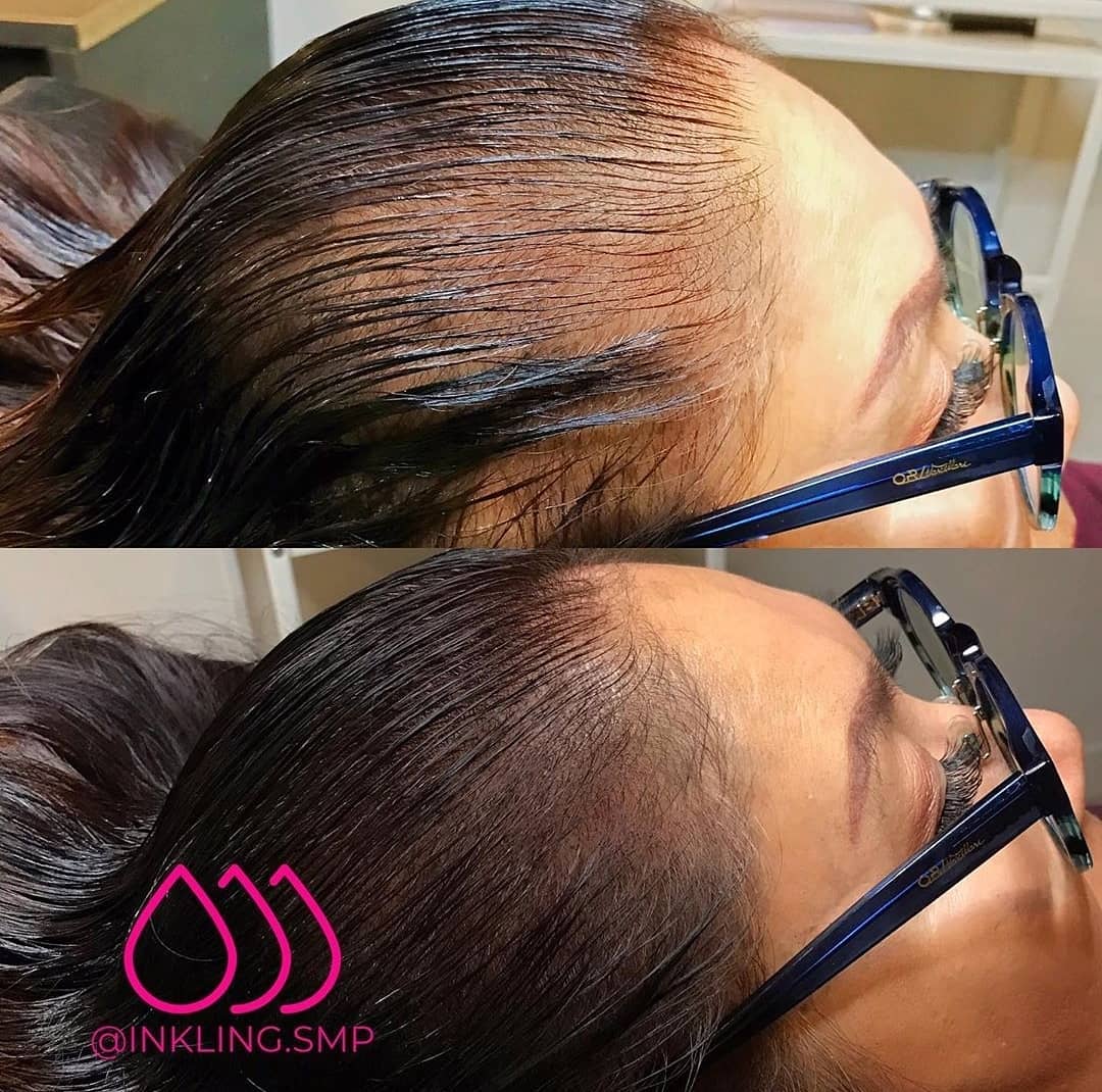 before-and-after-women-with-scalp-micropigmentation
