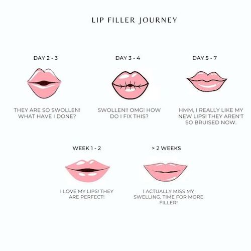 Lip Filler Healing Process