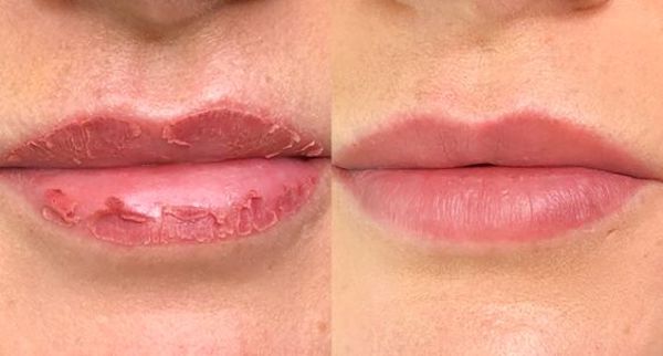 Anvendelse hugge Held og lykke Everything To Know About The Lip Blushing Healing Process