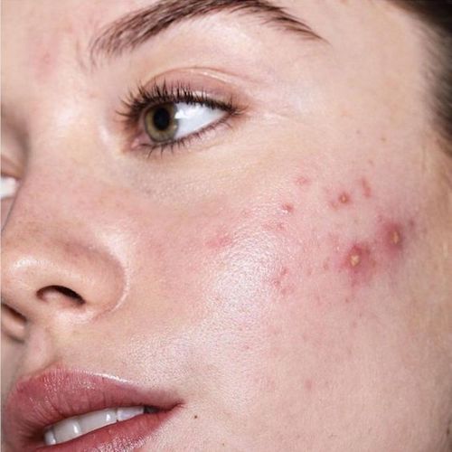 Nodular Acne