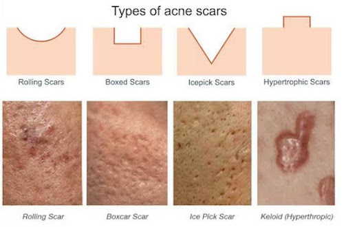 Types of Acne Scars Chart