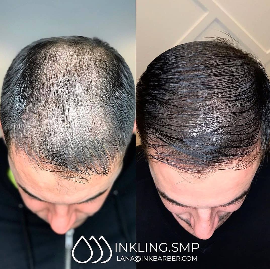 before-and-after-man-with-scalp-micropigmentation
