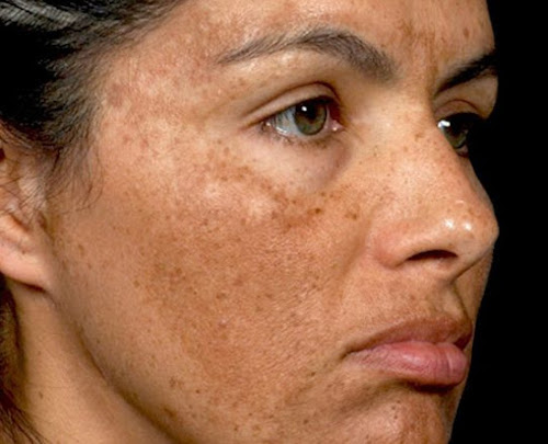 Hyperpigmentation 5