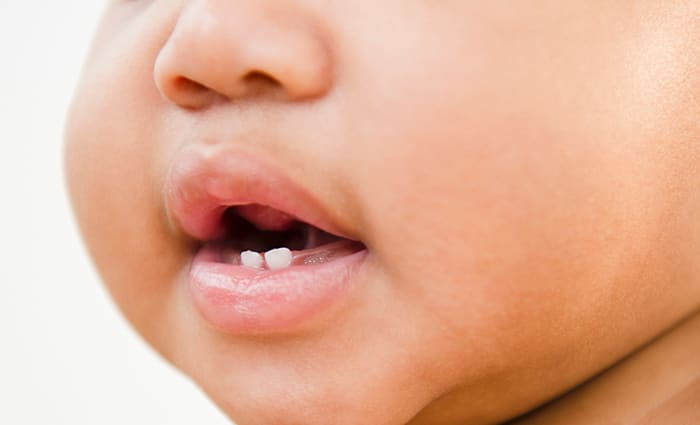 Vauvan hampaiden reikien oireet ja oikea hoito undefined