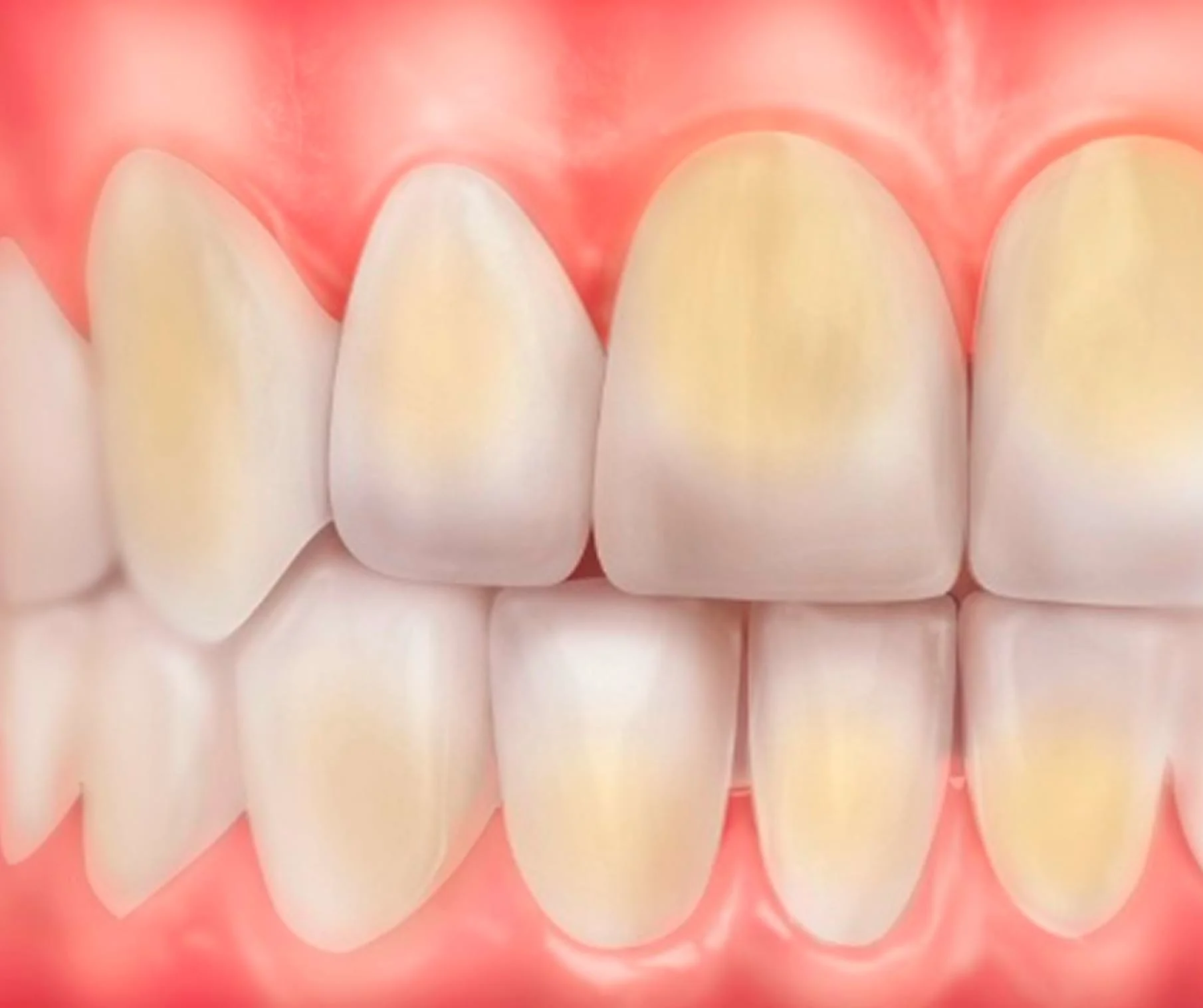 Lähikuva hampaista, joissa on keltaisia tahroja 