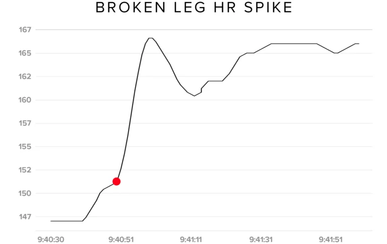 broken leg heart rate spike