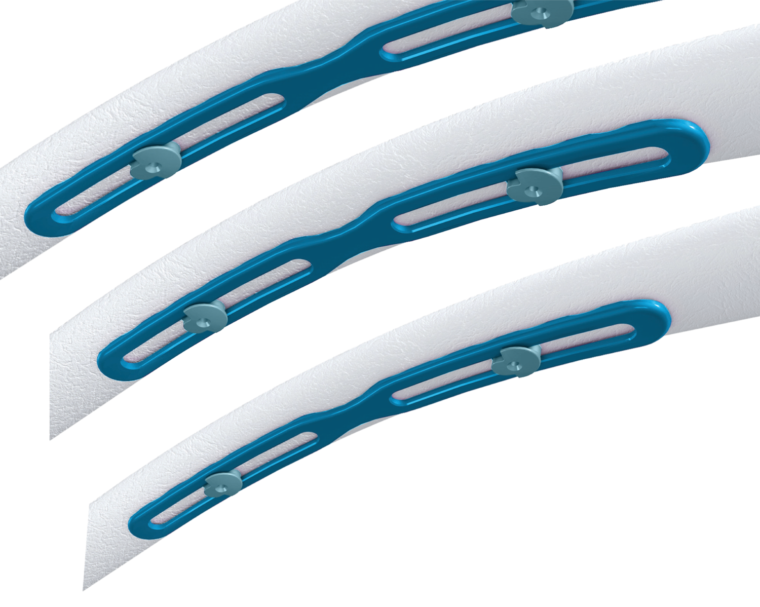 RibFix Advantage | image 