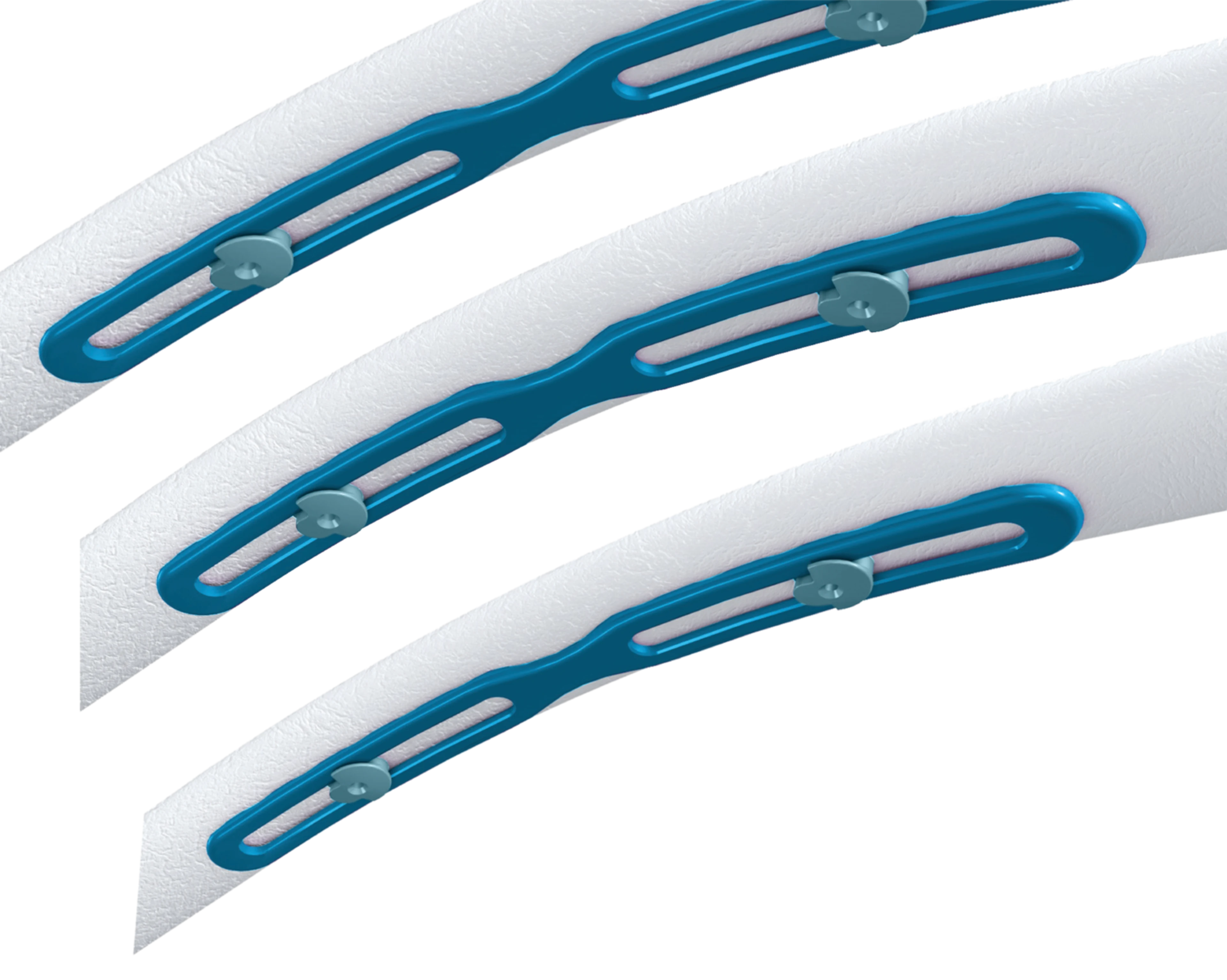 RibFix Advantage | image