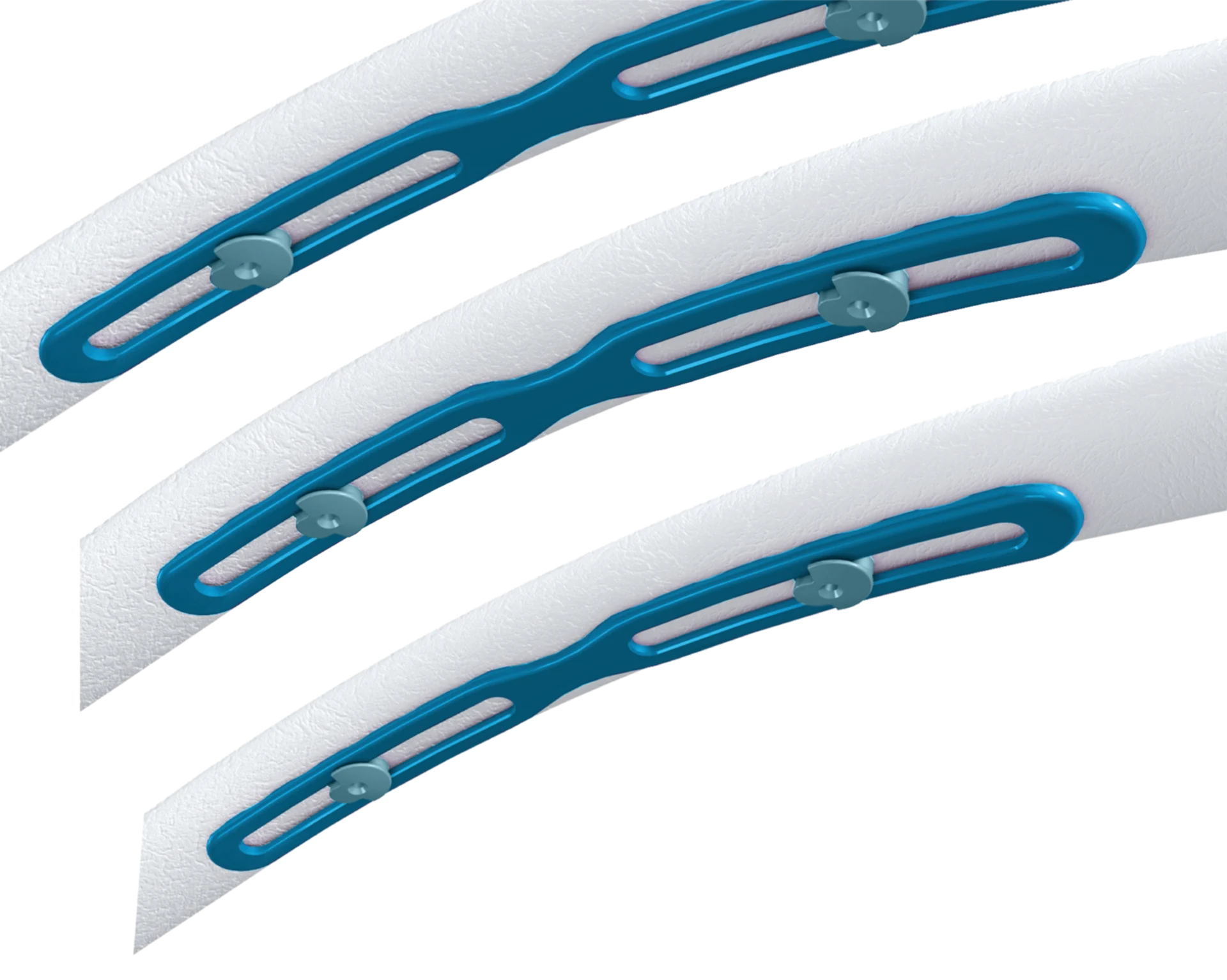 Zimmer Ribfix RibFix Advantage® | Zimmer Biomet | Zimmer Biomet