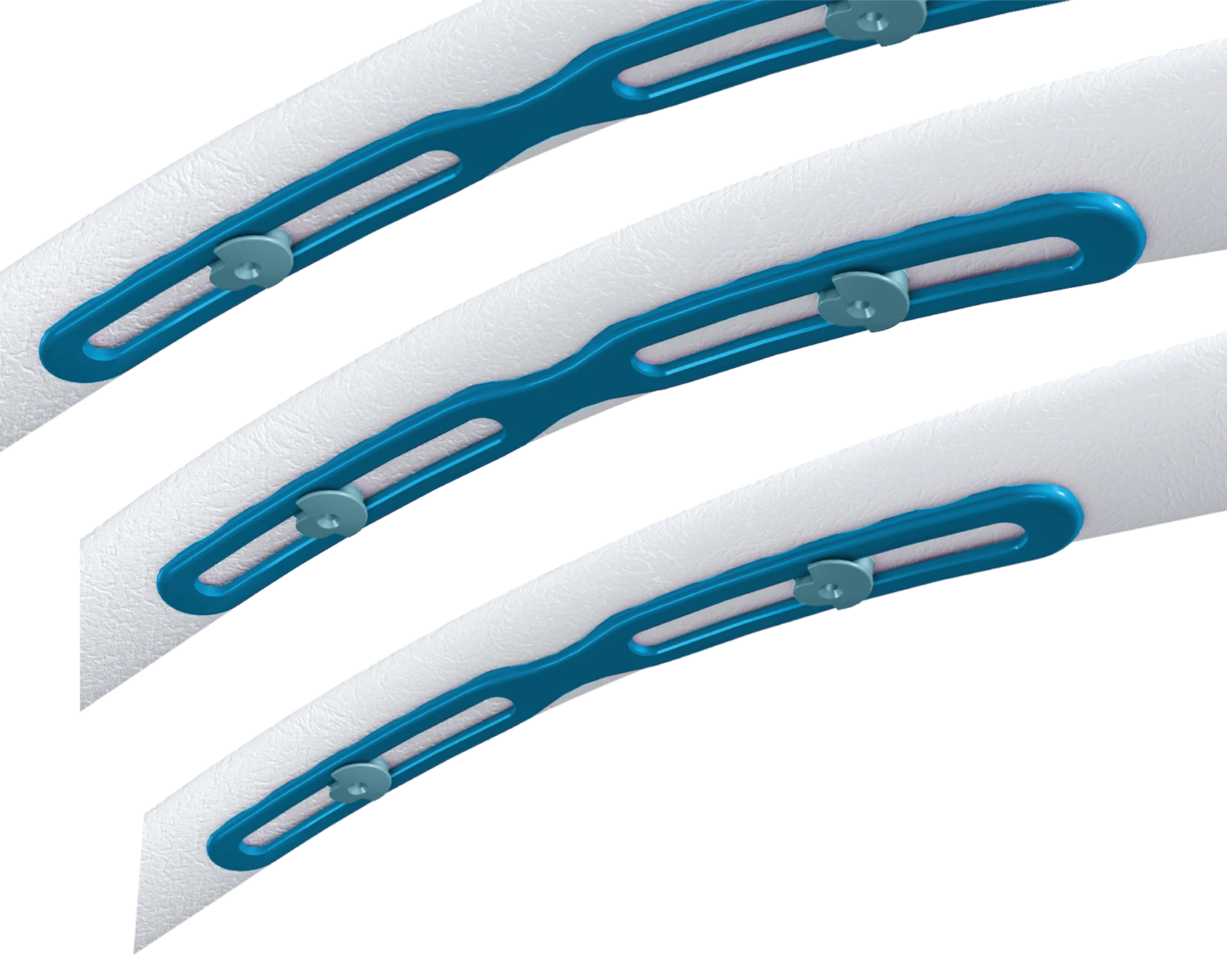 Zimmer Ribfix RibFix Advantage® | Zimmer Biomet | Zimmer Biomet