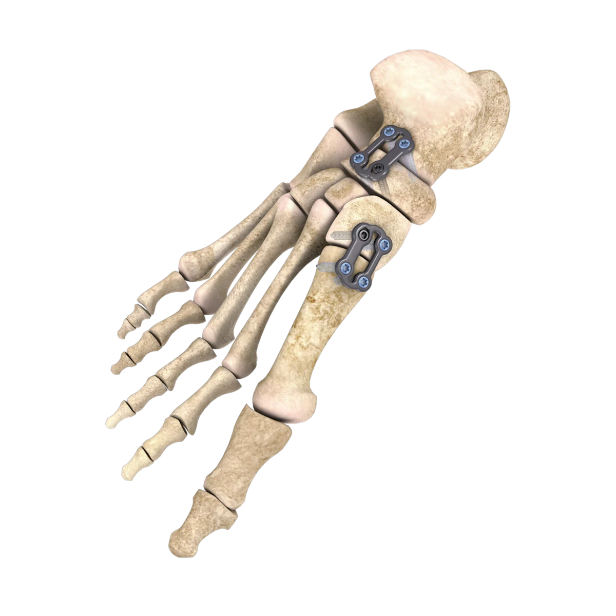 Foot and Ankle Solutions | Zimmer Biomet | Zimmer Biomet
