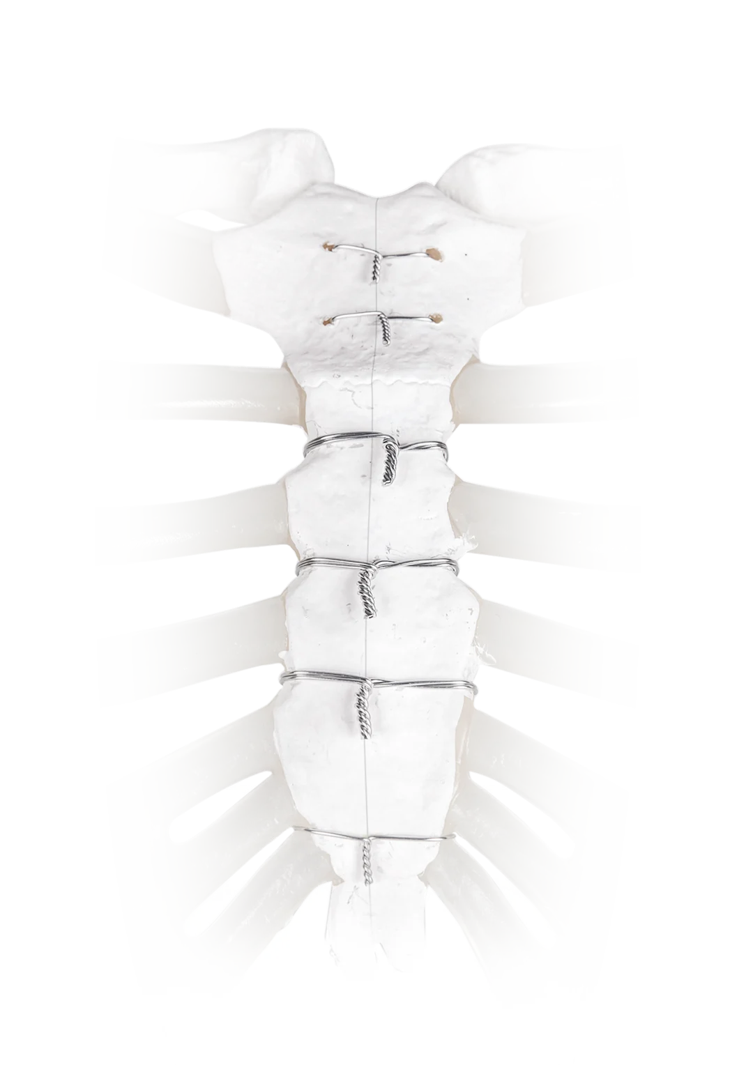 Zimmer Ribfix Thoracic | Zimmer Biomet | Zimmer Biomet
