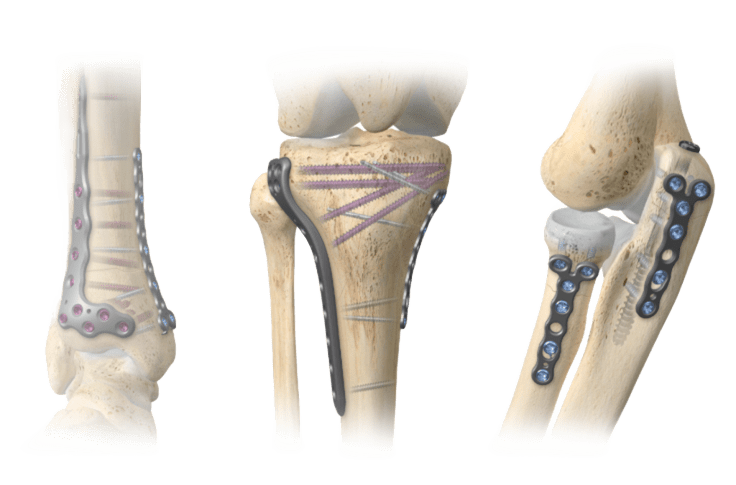 A.L.P.S. mvX™ Mini Fragment System Zimmer Biomet