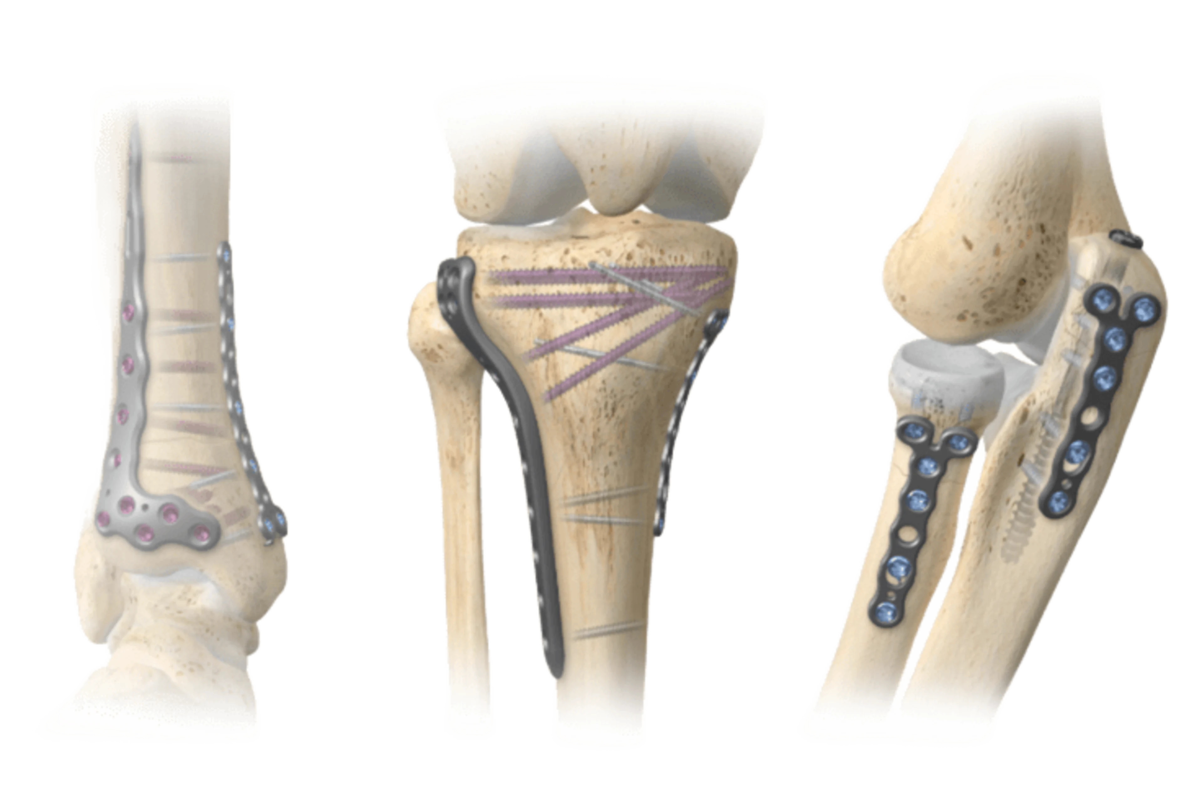 A.L.P.S. mvX™ Mini Fragment System Zimmer Biomet