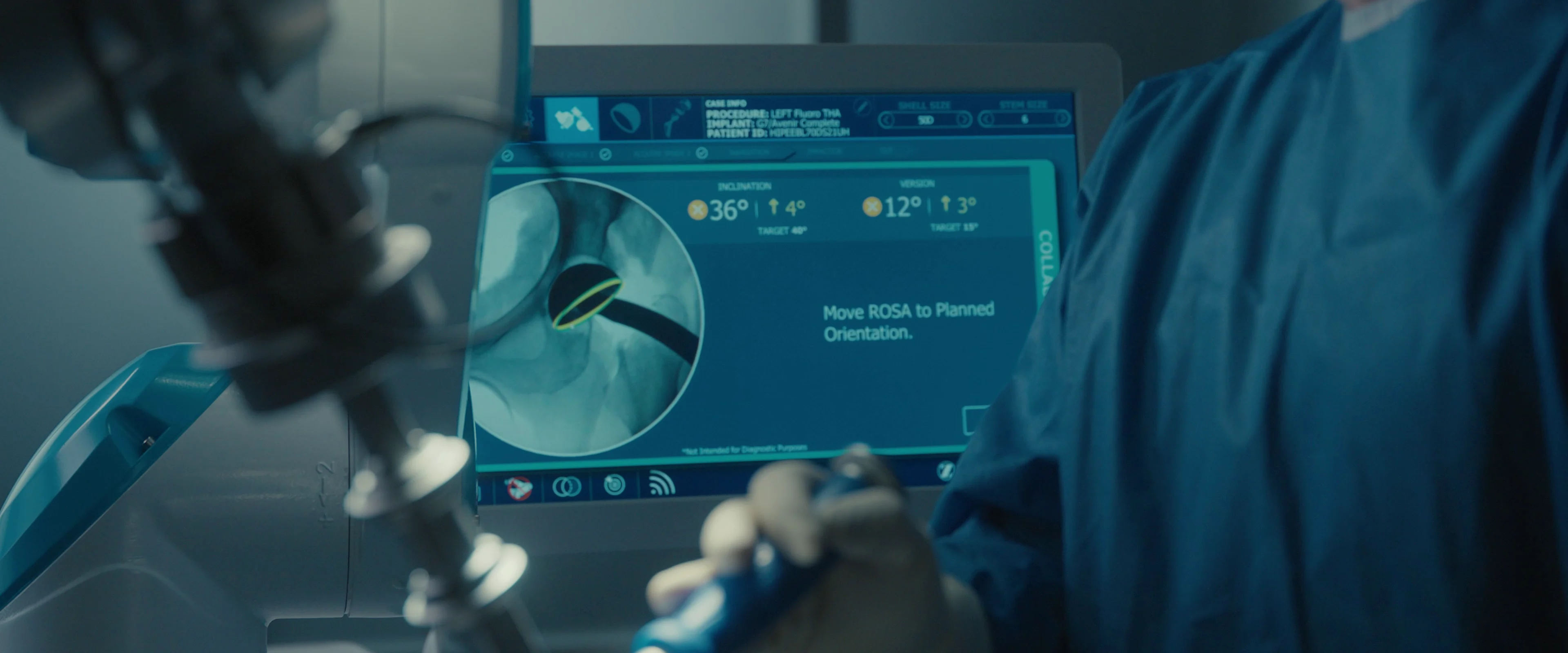 ZBEdge Hip Solutions Key Point | Personalised Procedure Image