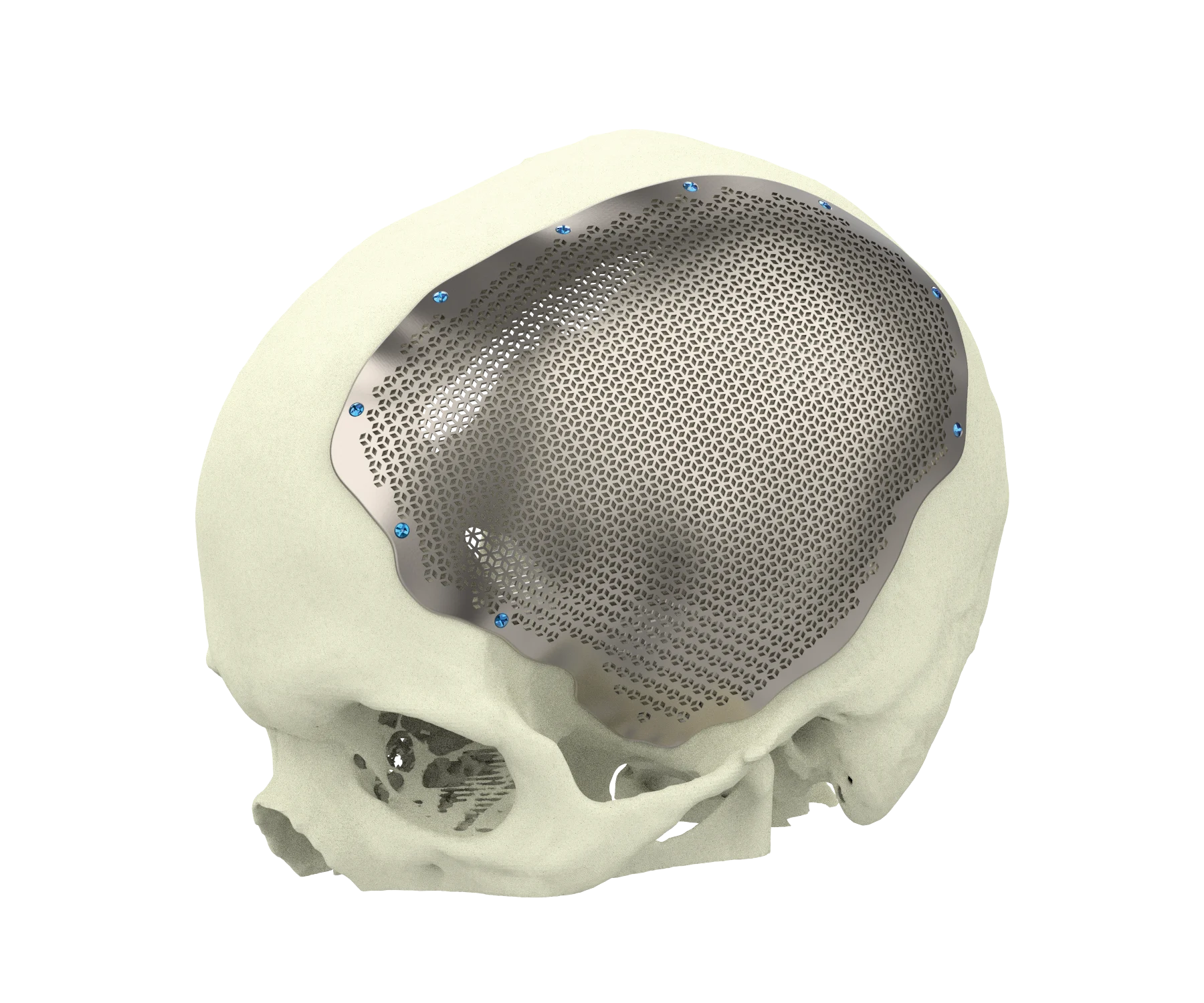One2One Titanuim Cranial | Main Product Image