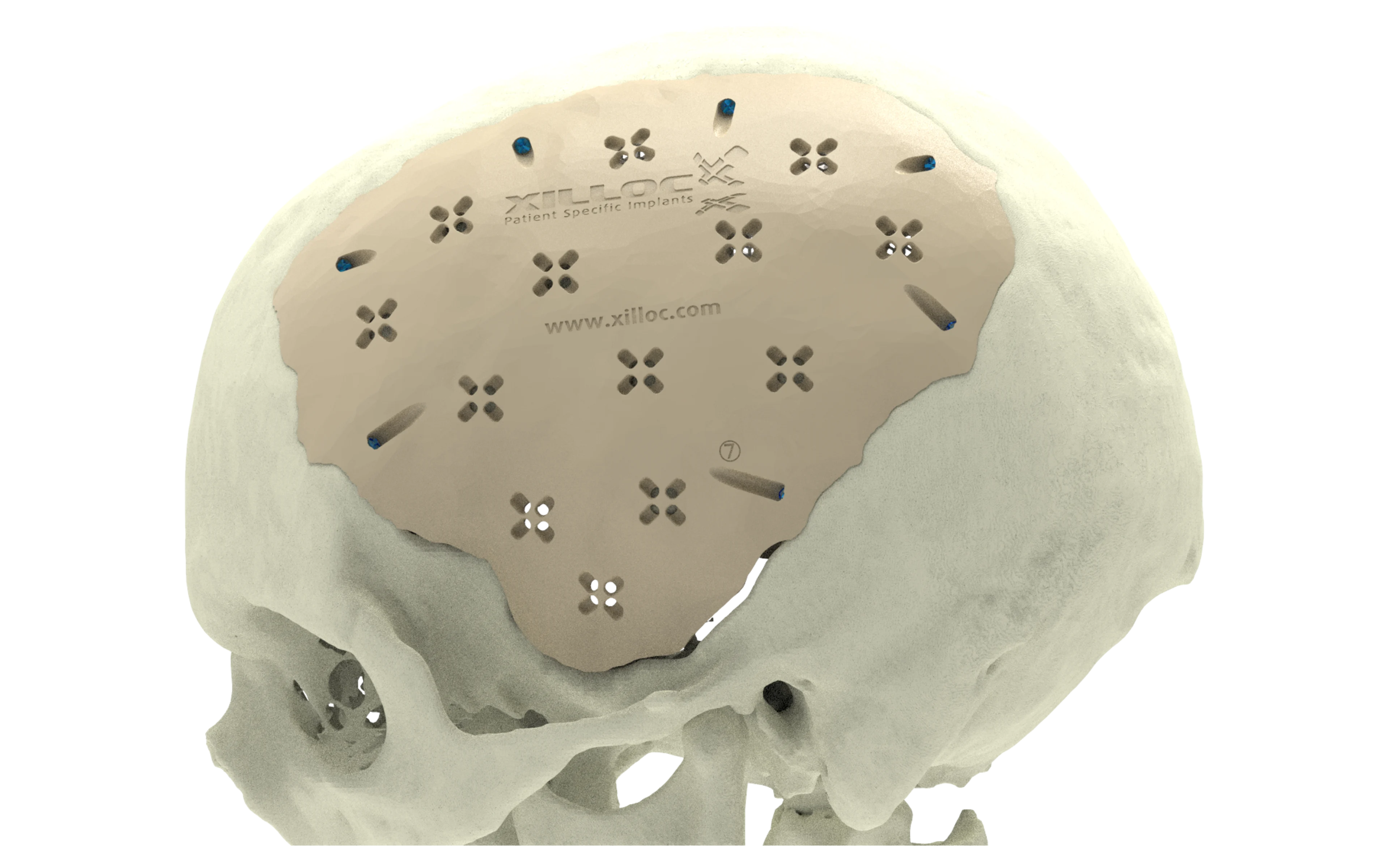 One2One PEEK Cranial | Main Product Image
