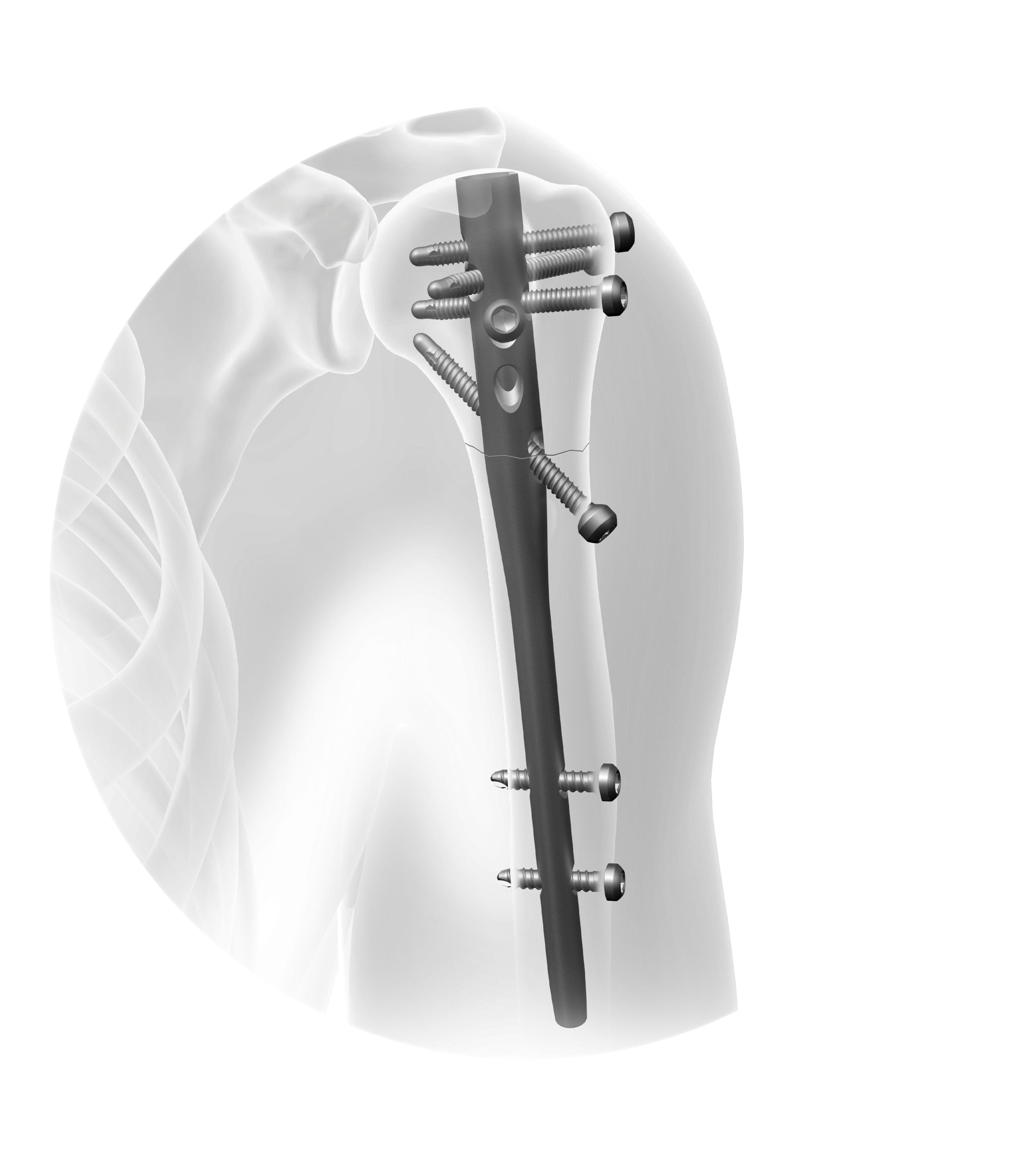 AFFIXUS Humeral | Main Image