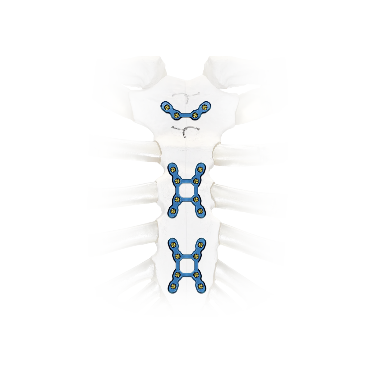 Zimmer Ribfix Thoracic | Zimmer Biomet | Zimmer Biomet