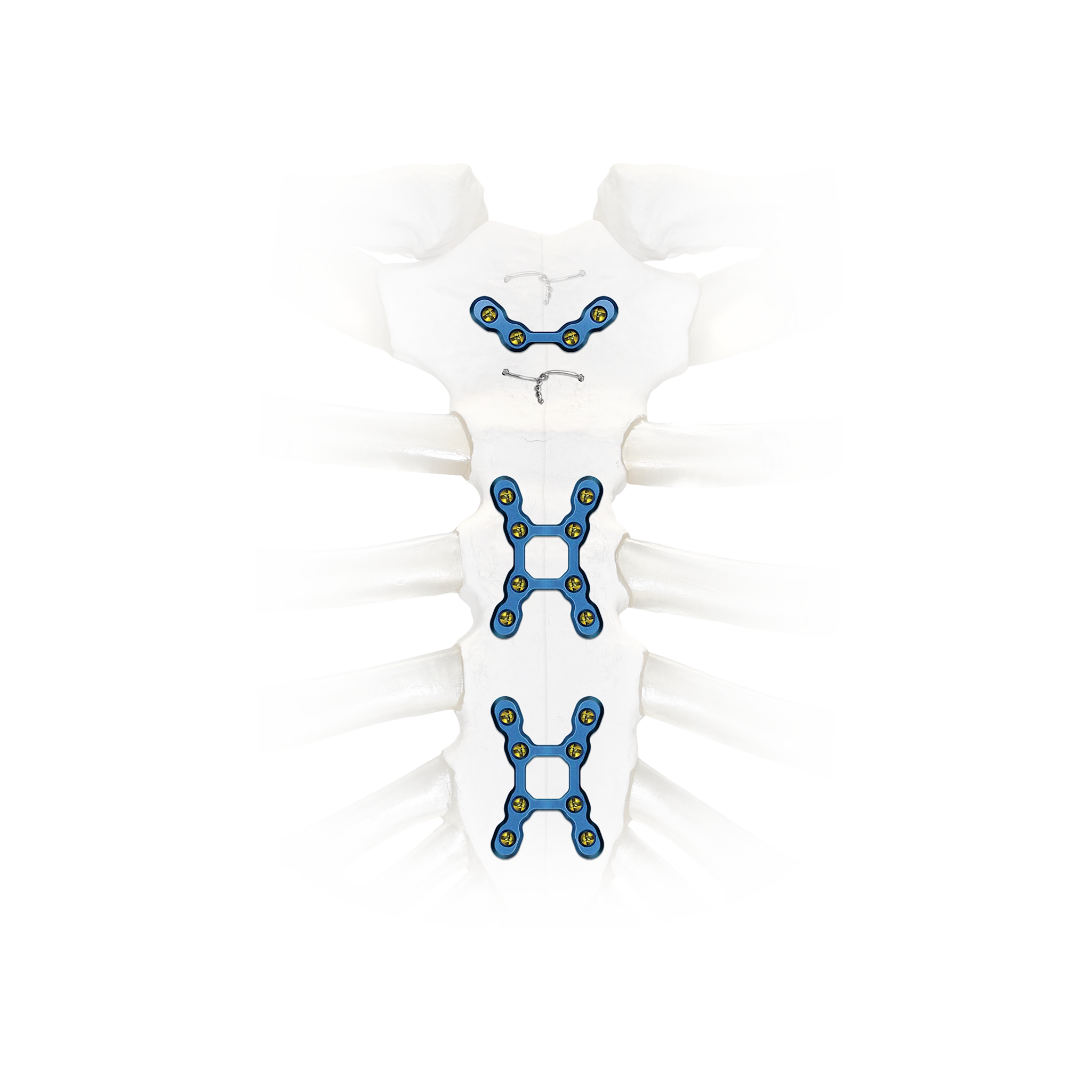 Zimmer Ribfx System Thoracic | Zimmer Biomet | Zimmer Biomet
