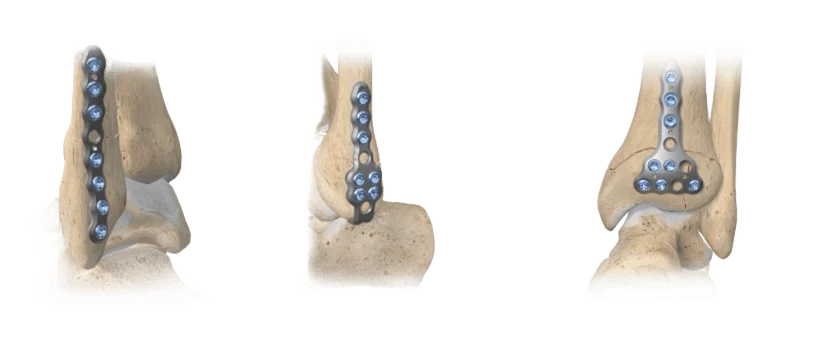 Benefits A.L.P.S. mvX ™ Ankle Fracture System