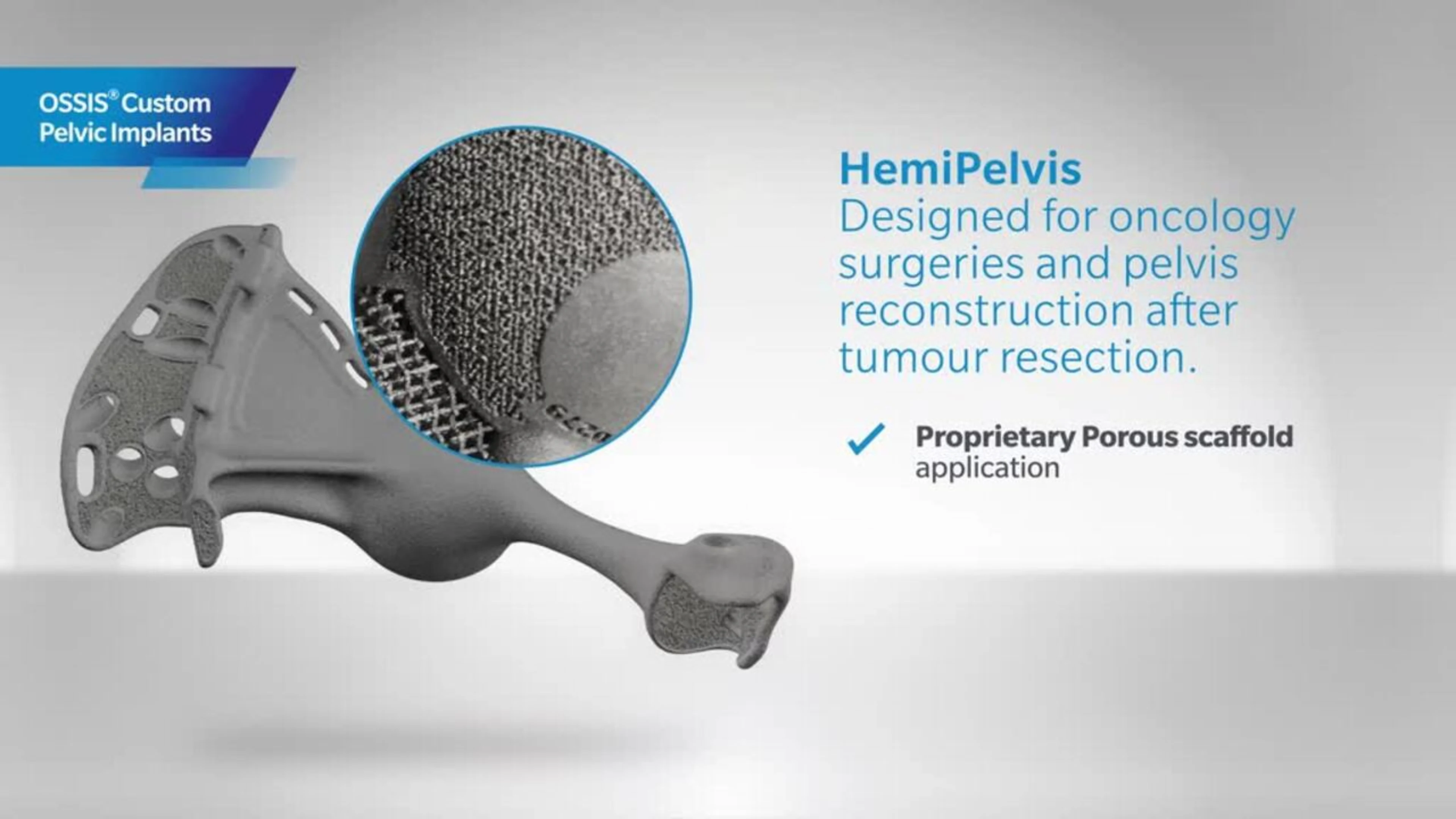 OSSIS Custom Pelvic Implant Video | Image