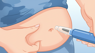 GLP-1（胰高糖素樣肽-1）受體促效劑，俗稱「瘦瘦針」，已從一個相對小眾的糖尿病治療選項，演變為一個更普遍性的醫藥，這股浪潮的核心，是諾和諾德（Novo Nordisk）的Semaglutide（司美格魯肽）與禮來（Eli Lilly）的Tirzepatide（替爾泊肽）[1, 2]。
數據顯示，僅在2023年，諾和諾德旗下的GLP-1藥物中，用於糖尿病的Ozempic銷售額便高達約140億美元，而其高劑量體重管理版本Wegovy也創造了45億美元的收入[3]。這些數字不僅代表著巨大的商業成功，更標誌著一個典範轉移：市場的狂熱證實了「體重管理」是一個規模可觀的醫療市場[4]。
