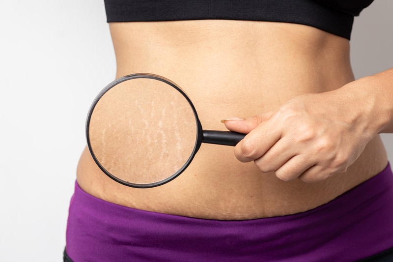 Stretch mark dan selulit, apa bedanya?