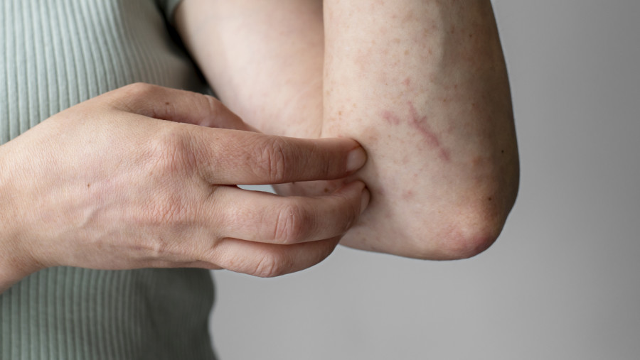 Dermatitis kontak iritan vs. alergi: Apa bedanya?