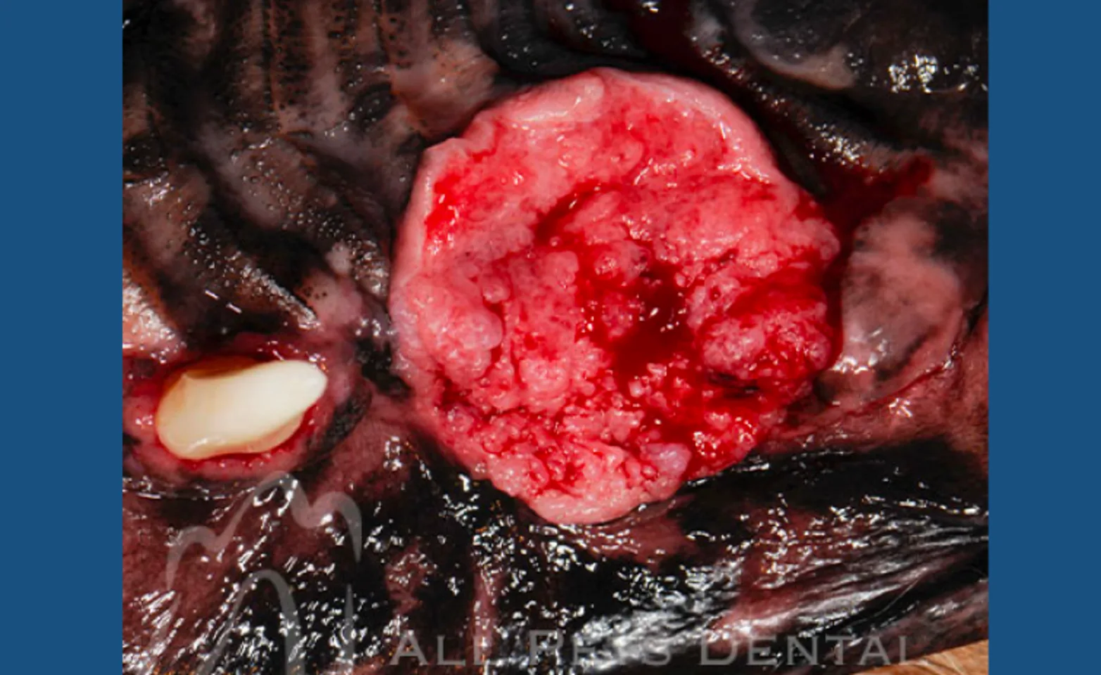 Squamous Cell Carcinoma Squamous Cell Carcinoma