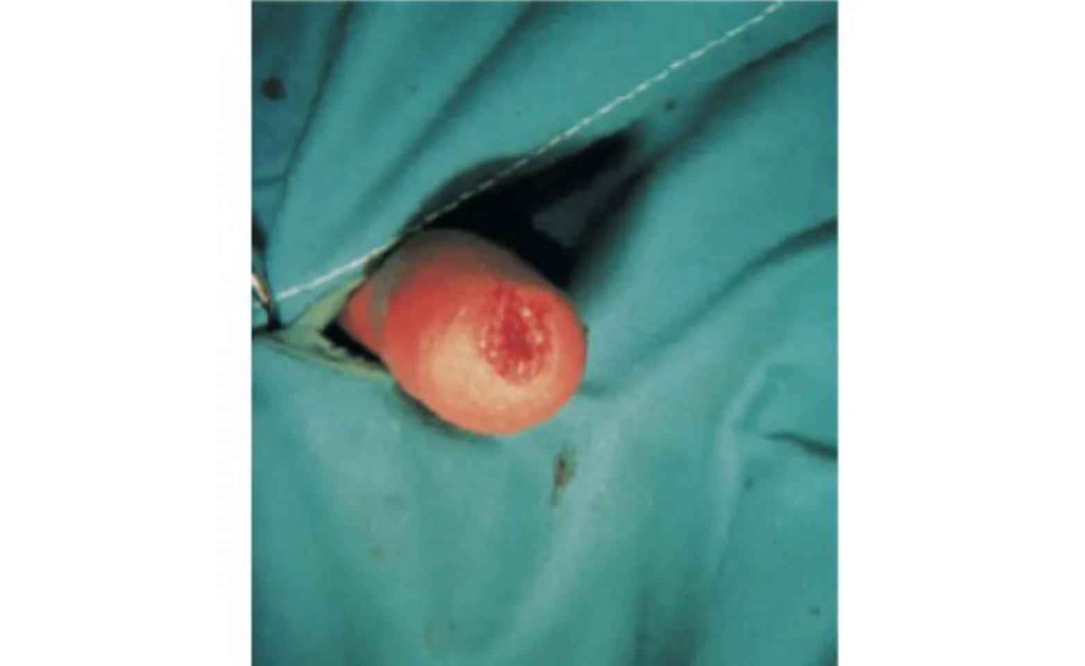 Figure 3. Final appearance of the penis after resection and anastomosis. Figure 3. Final appearance of the penis after resection and anastomosis.