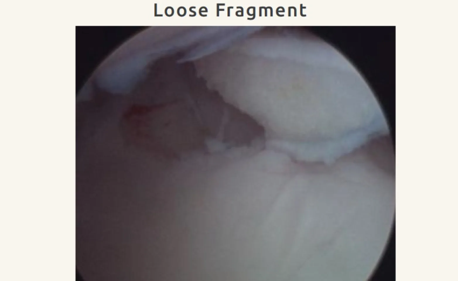 Loose Fragment Loose Fragment