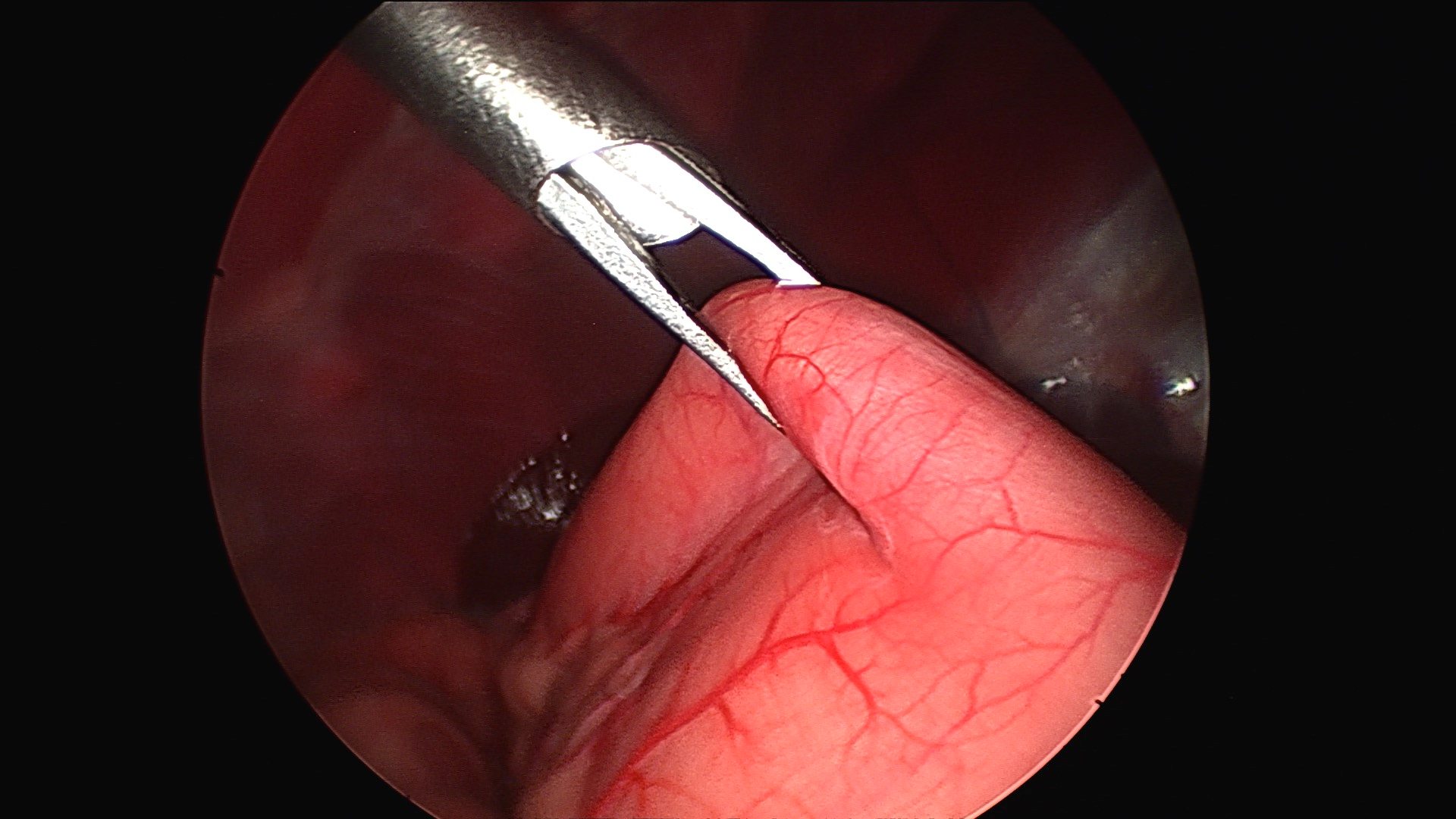 Forceps grabbing stomach