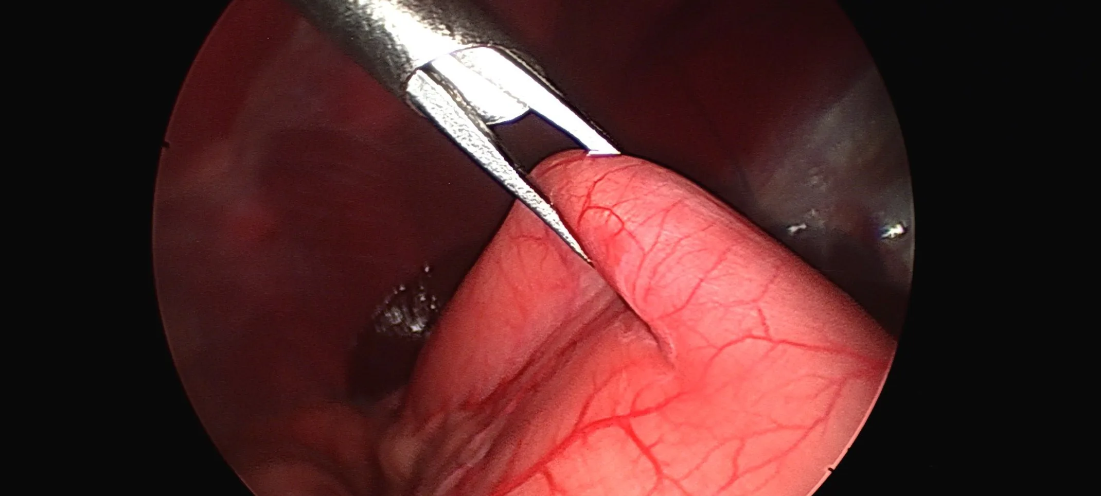 Forceps grabbing stomach Forceps grabbing stomach