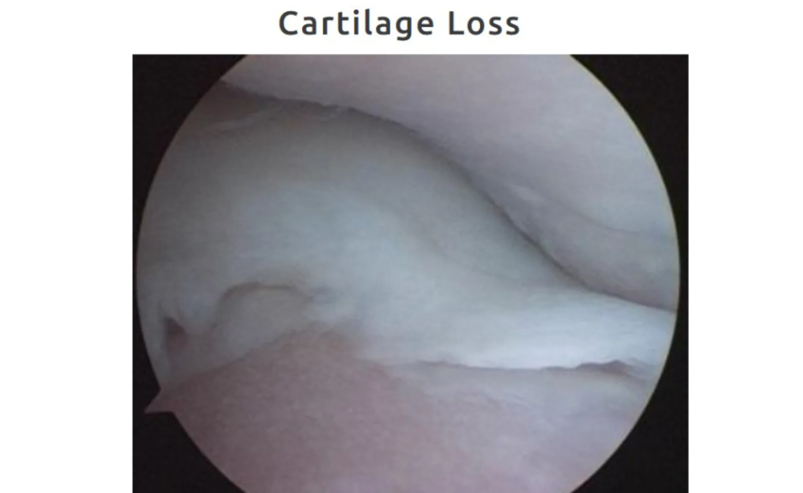 Cartilage Loss Cartilage Loss