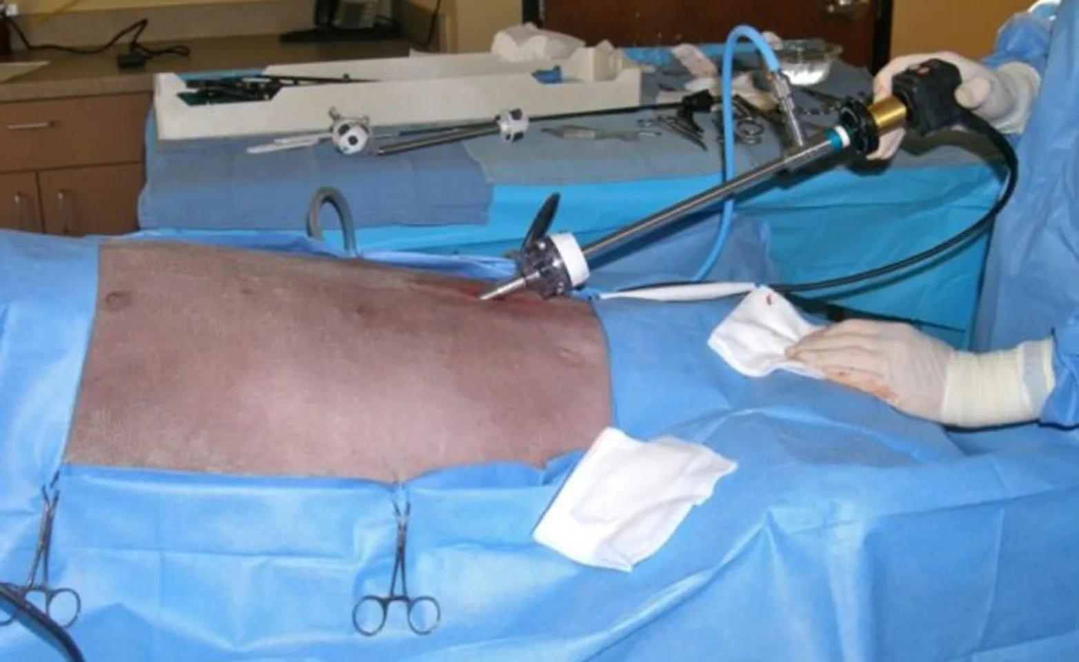 abdomen distended with carbon dioxide  abdomen distended with carbon dioxide