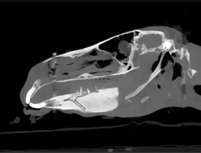 CT scan images of Fractured Navicular Bone CT scan images of Fractured Navicular Bone