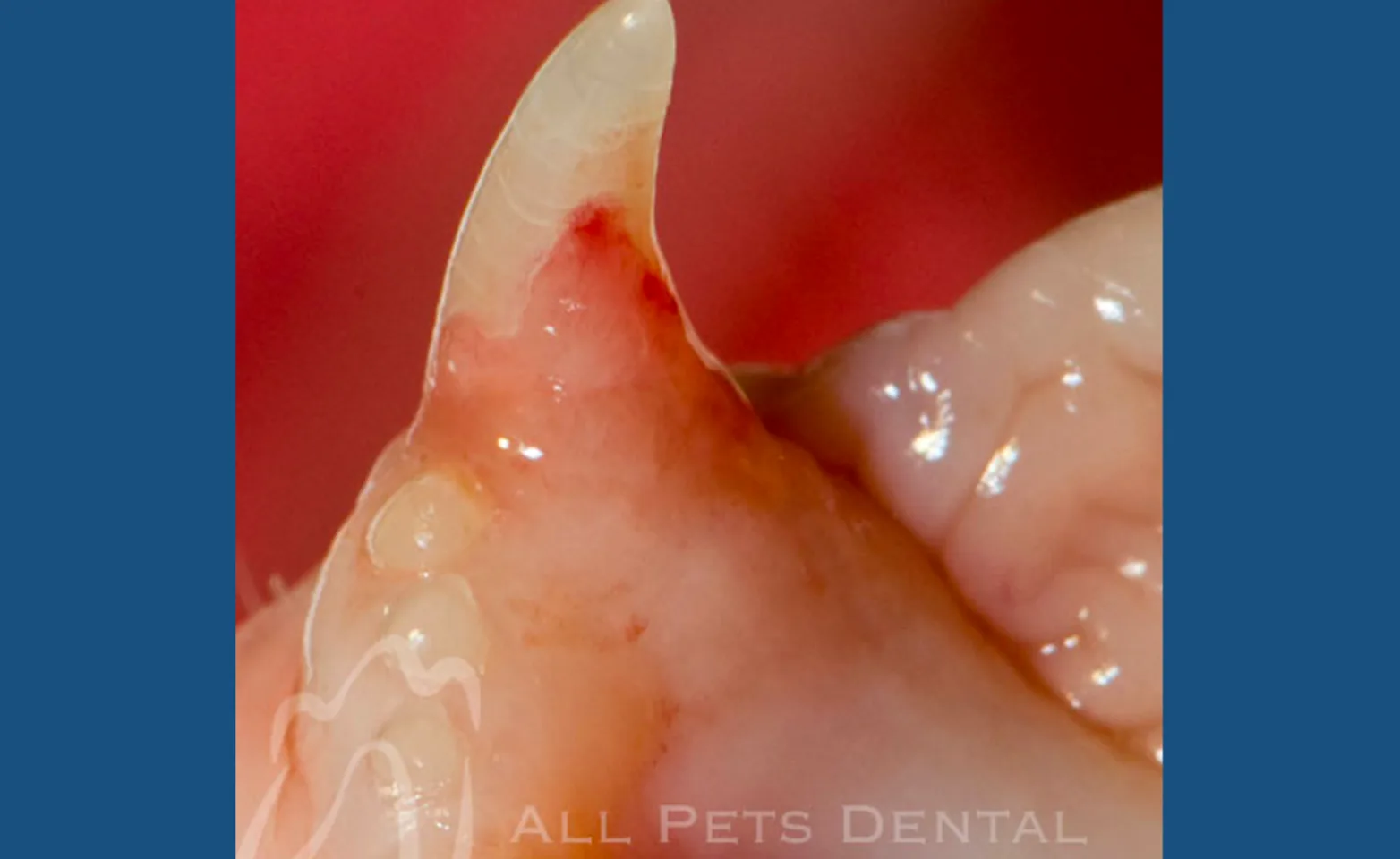 Tooth Resorption Stage 4 Tooth Resorption Stage 4