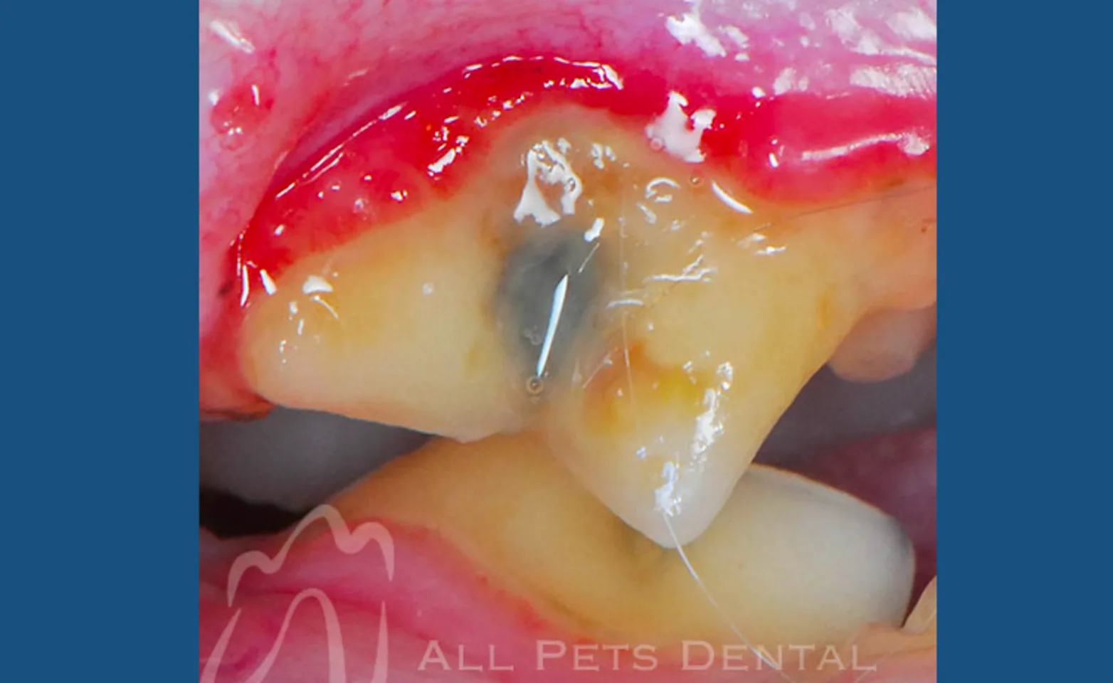 Periodontal Stage 3