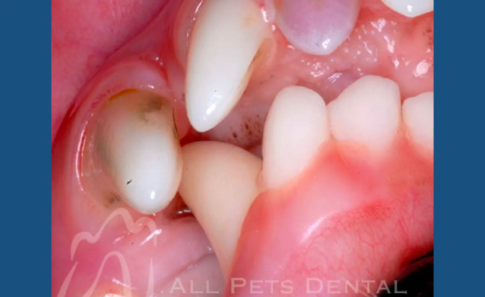 Lingually Displaced Mandibular Canines Lingually Displaced Mandibular Canines