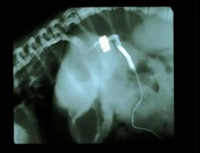 Shunt valve with ameroid ring placed around it Shunt valve with ameroid ring placed around it
