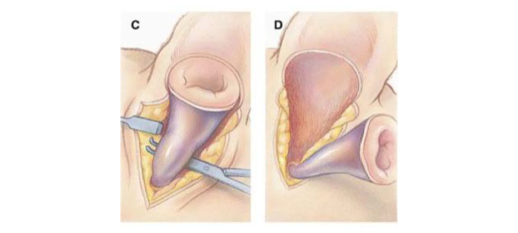 Careful blunt dissection is then used to separate the cartilaginous ear canal from the surrounding soft tissues of the head. Careful blunt dissection is then used to separate the cartilaginous ear canal from the surrounding soft tissues of the head.