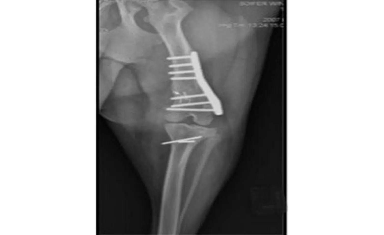 Angular deformity of the femur Angular deformity of the femur
