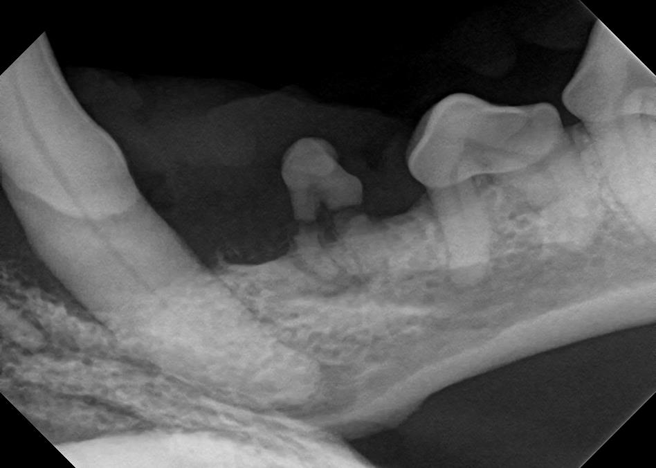 In this image, the crown (this visible part of the tooth above the gum line that we can see) is completely fractured away from the roots. This tooth looked normal when you opened the mouth and looked at it.