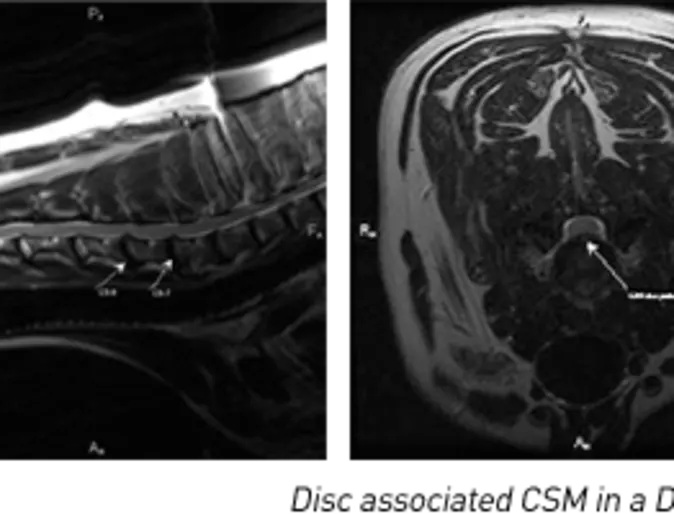 Cervical Spondylomyelopathy Cervical Spondylomyelopathy